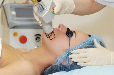 Arten der Laser-Gesichtshautverjüngung